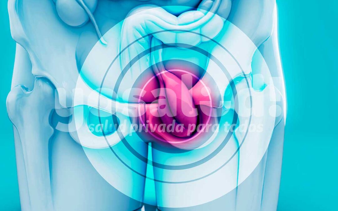 ¿Te salió una “bolita” en la ingle? Puede ser una hernia